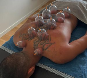 Cupping